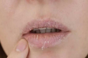 এই গরমেও ফাটছে ঠোঁট?